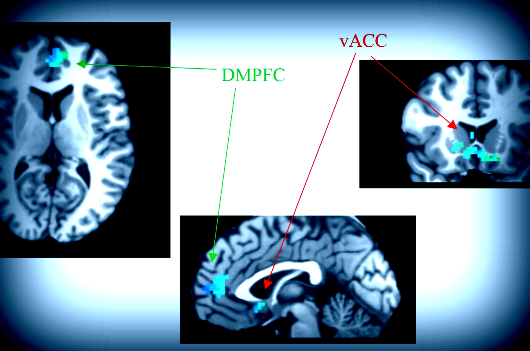 Price et al Biological Psychiatry 2018