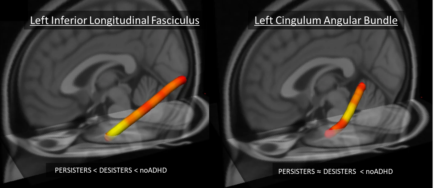 Left Inferior Longitudinal Fasciculus / Left Cingulum Angular Bundle